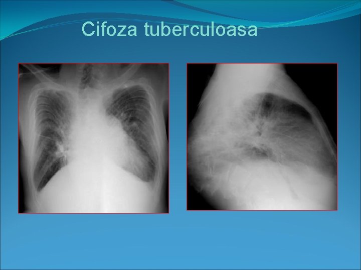 Cifoza tuberculoasa 