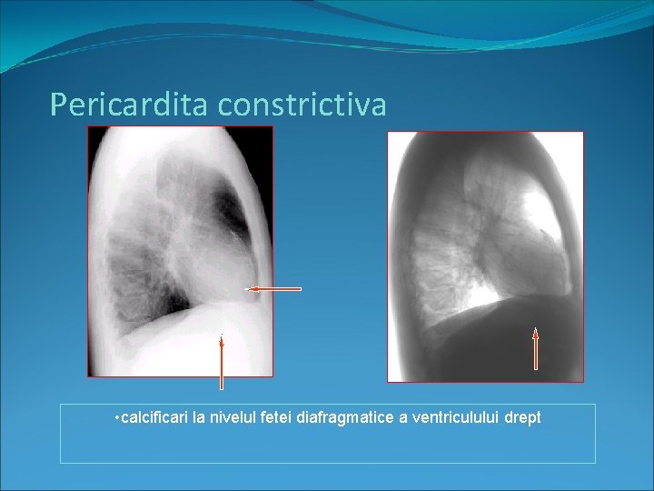 Pericardita constrictiva • calcificari la nivelul fetei diafragmatice a ventriculului drept 