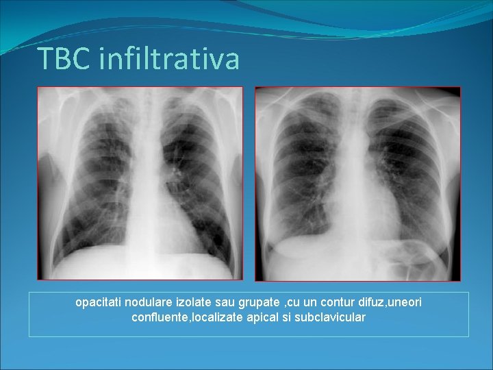 TBC infiltrativa opacitati nodulare izolate sau grupate , cu un contur difuz, uneori confluente,