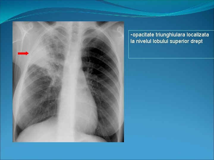  • opacitate triunghiulara localizata la nivelul lobului superior drept 