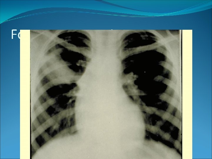 Forma pneumonica 