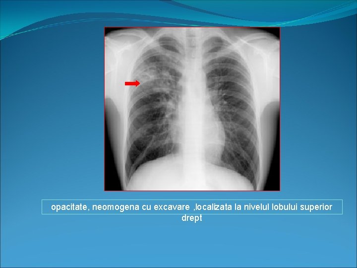 opacitate, neomogena cu excavare , localizata la nivelul lobului superior drept 