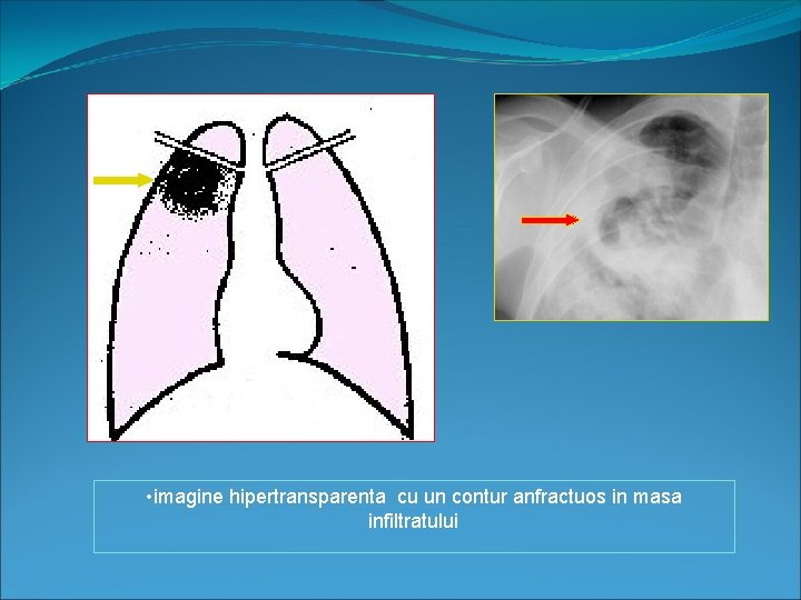  • imagine hipertransparenta cu un contur anfractuos in masa infiltratului 