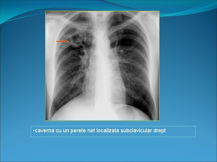  • caverna cu un perete net localizata subclavicular drept 