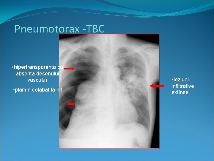 Pneumotorax -TBC • hipertransparenta cu absenta desenului vascular • plamin colabat la hil •