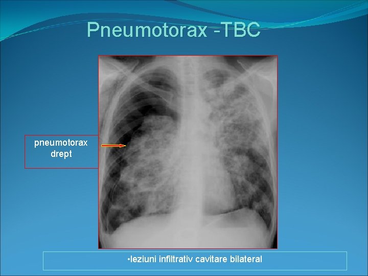 Pneumotorax -TBC pneumotorax drept • leziuni infiltrativ cavitare bilateral 