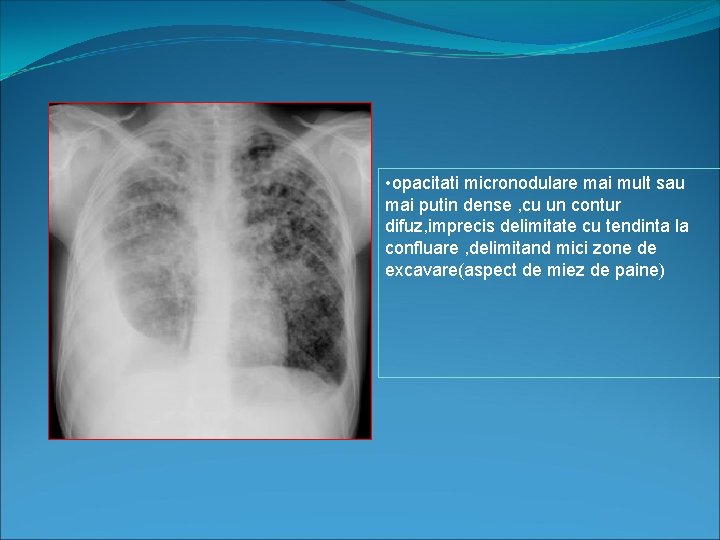  • opacitati micronodulare mai mult sau mai putin dense , cu un contur