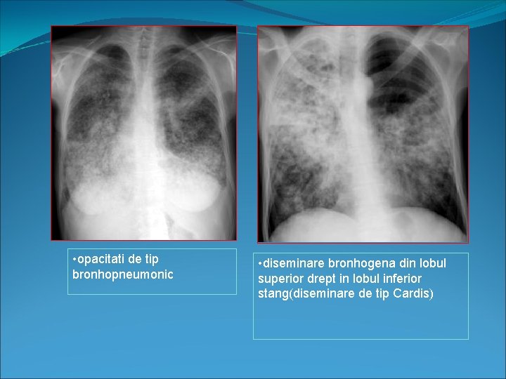  • opacitati de tip bronhopneumonic • diseminare bronhogena din lobul superior drept in