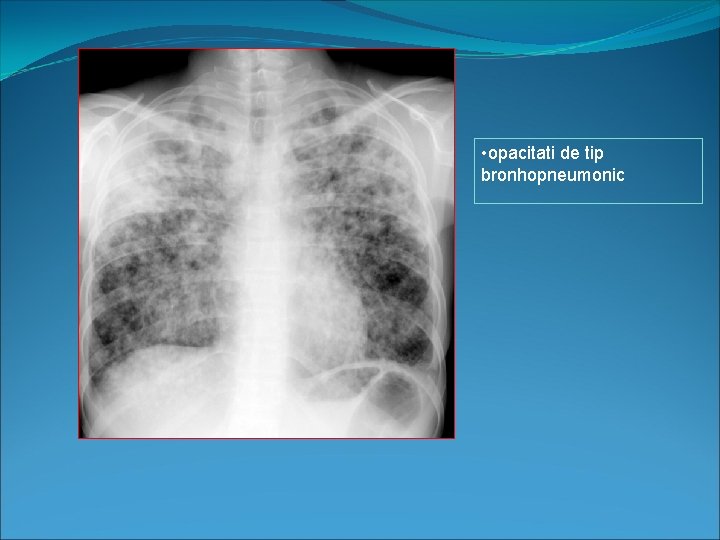  • opacitati de tip bronhopneumonic 