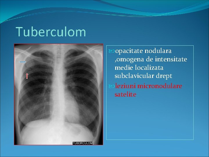 Tuberculom opacitate nodulara , omogena de intensitate medie localizata subclavicular drept leziuni micronodulare satelite