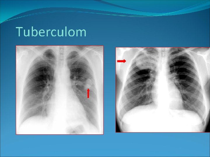 Tuberculom 