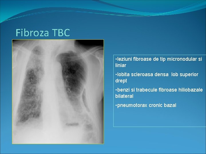 Fibroza TBC • leziuni fibroase de tip micronodular si liniar • lobita scleroasa densa