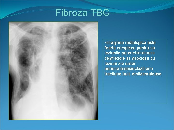 Fibroza TBC • imaginea radiologica este foarte complexa pentru ca leziunile parenchimatoase cicatriciale se