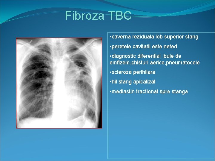 Fibroza TBC • caverna reziduala lob superior stang • peretele cavitatii este neted •