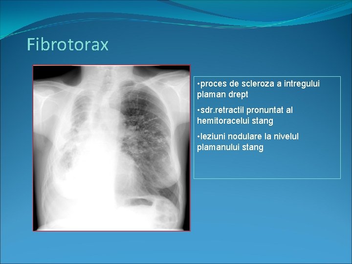 Fibrotorax • proces de scleroza a intregului plaman drept • sdr. retractil pronuntat al