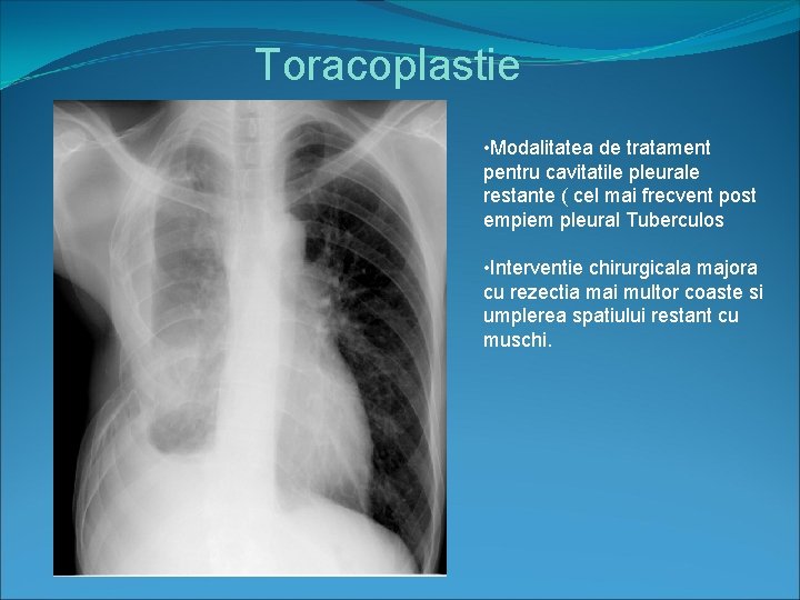 Toracoplastie • Modalitatea de tratament pentru cavitatile pleurale restante ( cel mai frecvent post