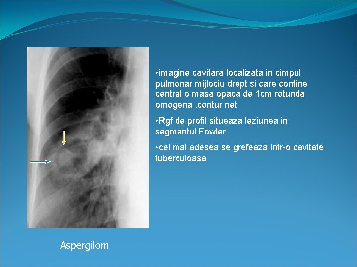  • imagine cavitara localizata in cimpul pulmonar mijlociu drept si care contine central