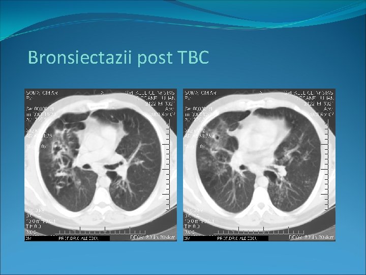 Bronsiectazii post TBC 