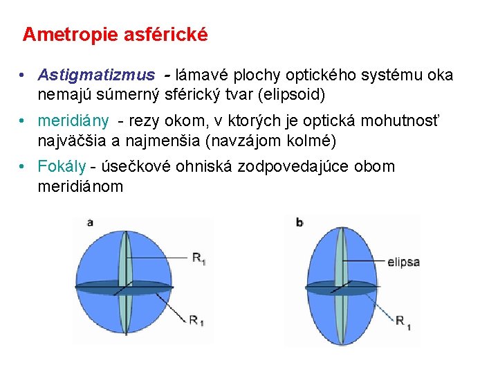 Ametropie asférické • Astigmatizmus - lámavé plochy optického systému oka nemajú súmerný sférický tvar