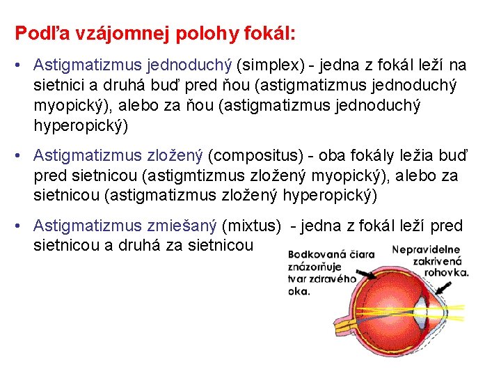 Podľa vzájomnej polohy fokál: • Astigmatizmus jednoduchý (simplex) - jedna z fokál leží na