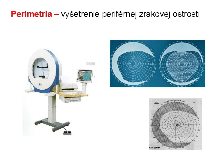 Perimetria – vyšetrenie periférnej zrakovej ostrosti 