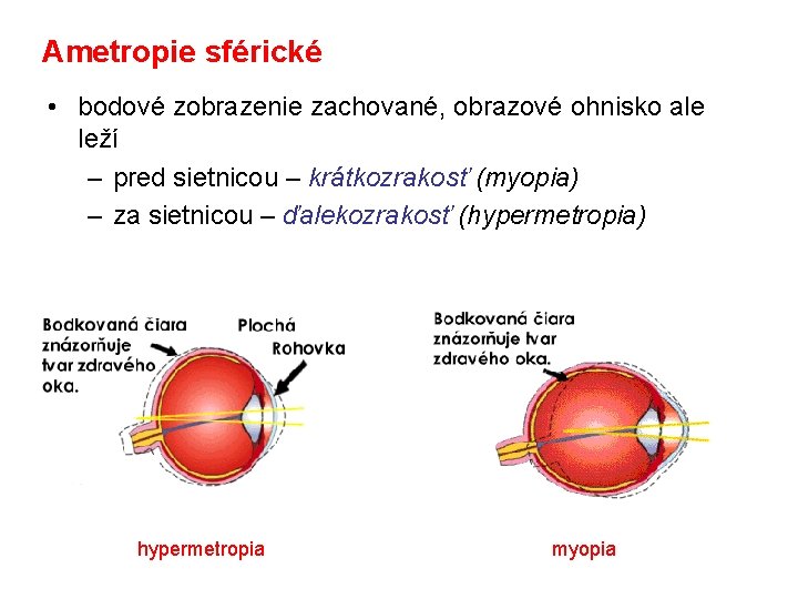 Ametropie sférické • bodové zobrazenie zachované, obrazové ohnisko ale leží – pred sietnicou –