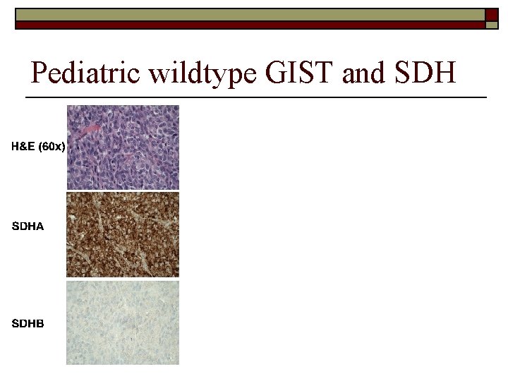 Pediatric wildtype GIST and SDH 