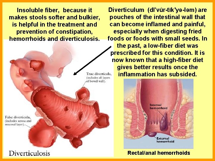 Insoluble fiber, because it makes stools softer and bulkier, is helpful in the treatment