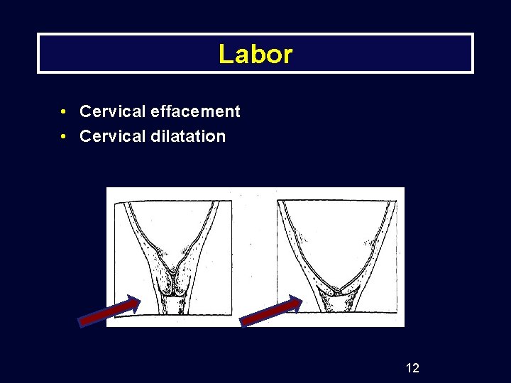 Labor • Cervical effacement • Cervical dilatation 12 