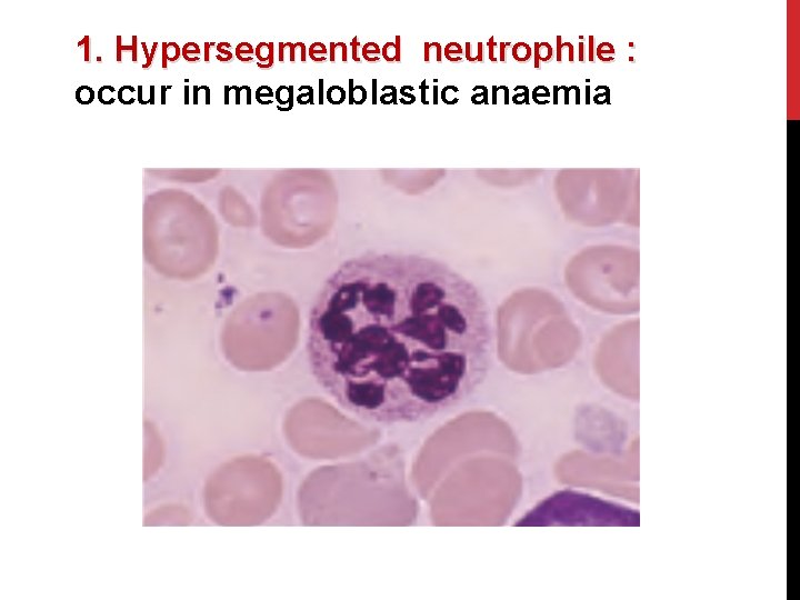 1. Hypersegmented neutrophile : occur in megaloblastic anaemia 