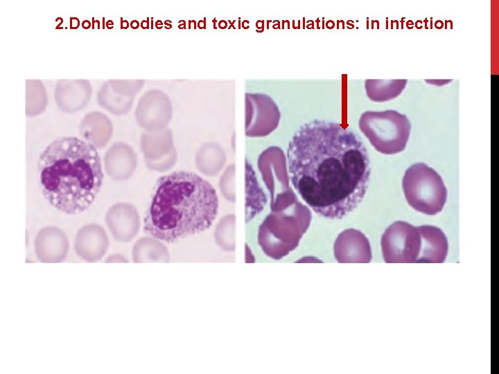 2. Dohle bodies and toxic granulations: in infection 