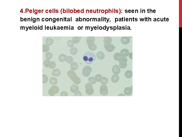 4. Pelger cells (bilobed neutrophils): seen in the bilobed neutrophils): benign congenital abnormality, patients