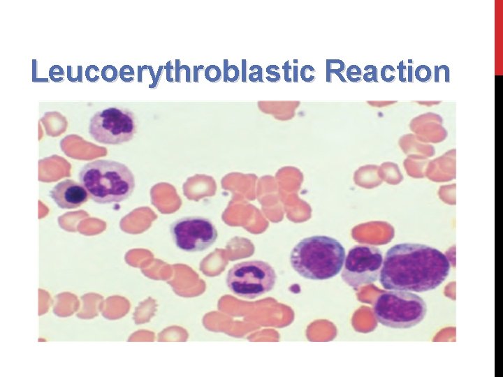 Leucoerythroblastic Reaction 