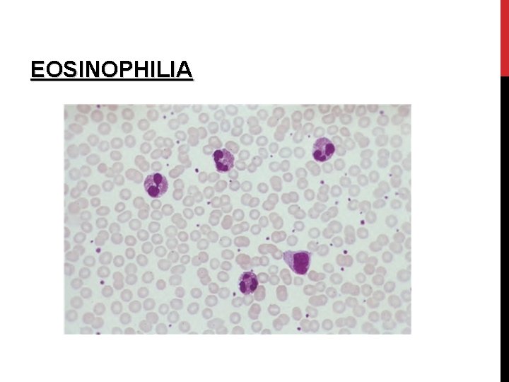 EOSINOPHILIA 