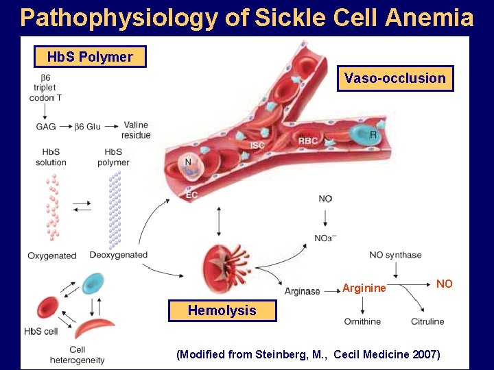 Pathophysiology of Sickle Cell Anemia Hb. S Polymer Vaso-occlusion Arginine NO Hemolysis (Modified from