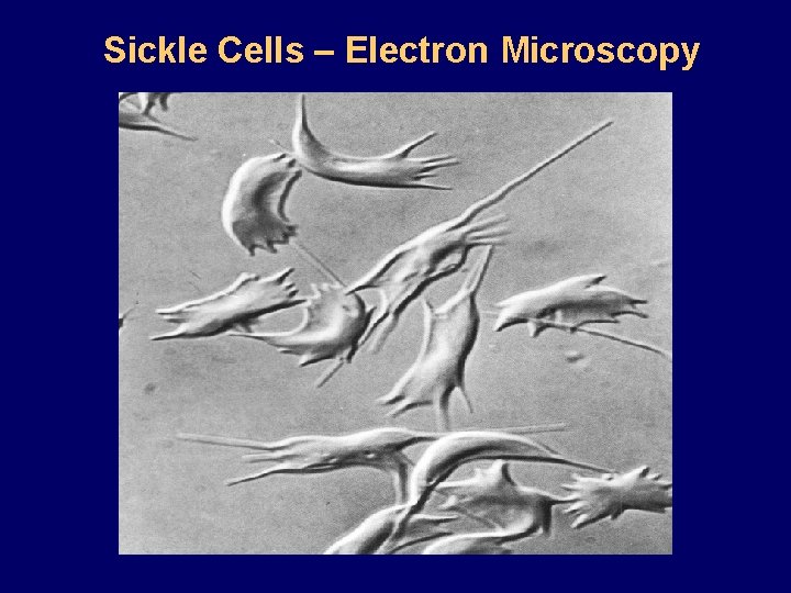 Sickle Cells – Electron Microscopy 