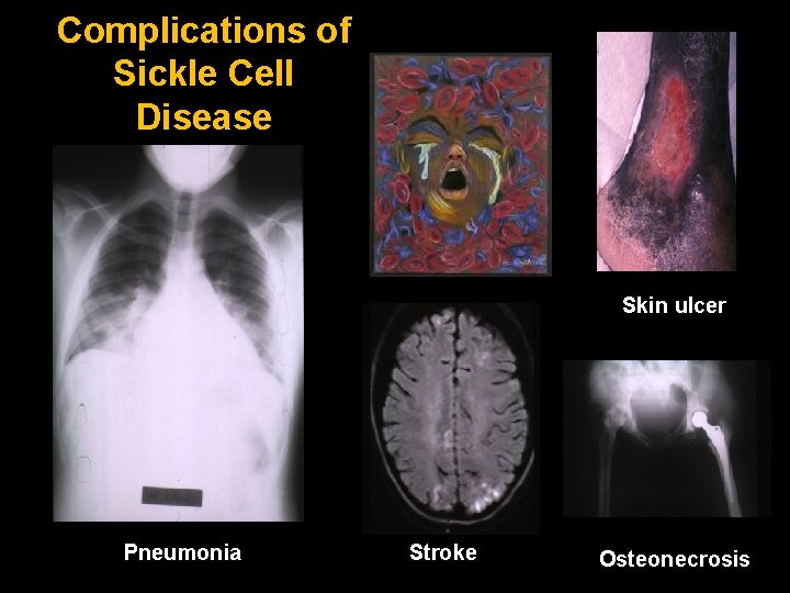 Complications of Sickle Cell Disease Pneumonia Skin ulcer Stroke Osteonecrosis 