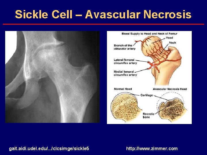 Sickle Cell – Avascular Necrosis gait. aidi. udel. edu/. . . /clcsimge/sickle 5 http: