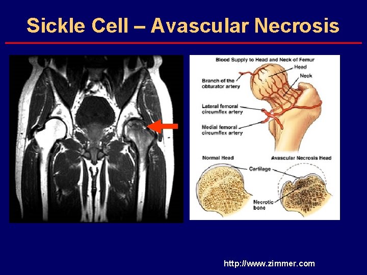 Sickle Cell – Avascular Necrosis http: //www. zimmer. com 