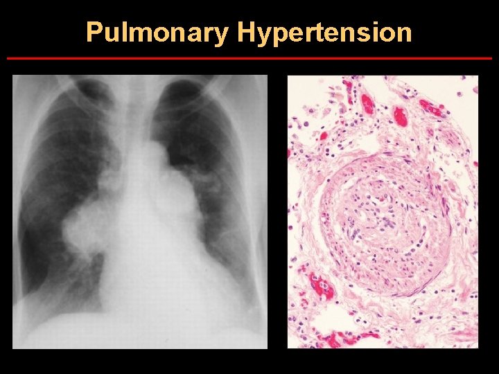 Pulmonary Hypertension 