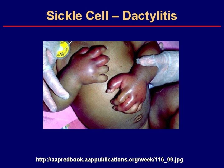 Sickle Cell – Dactylitis http: //aapredbook. aappublications. org/week/116_09. jpg 