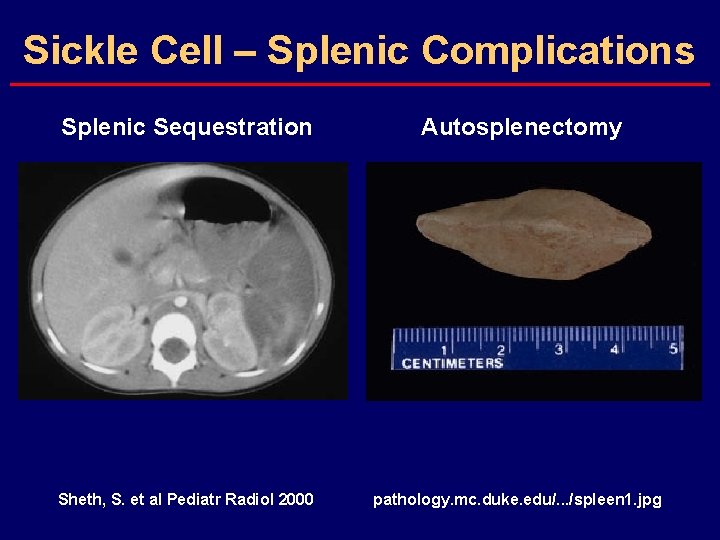 Sickle Cell – Splenic Complications Splenic Sequestration Autosplenectomy Sheth, S. et al Pediatr Radiol