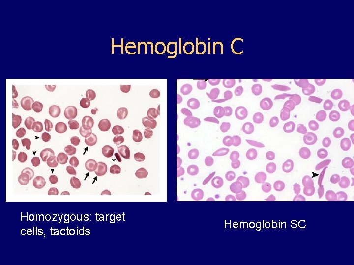 Hemoglobin C Homozygous: target cells, tactoids Hemoglobin SC 