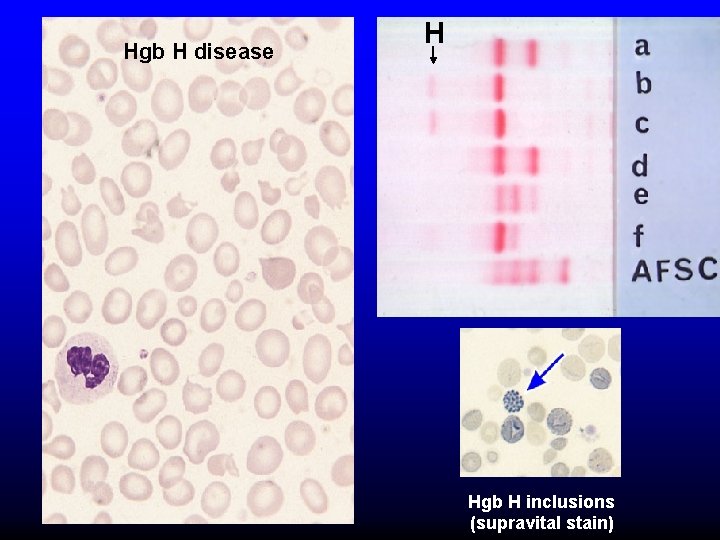 Hgb H disease H Hgb H inclusions (supravital stain) 