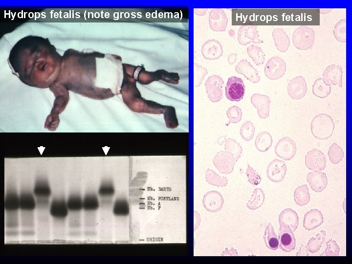 Hydrops fetalis (note gross edema) Hydrops fetalis 