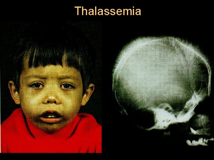 Thalassemia 
