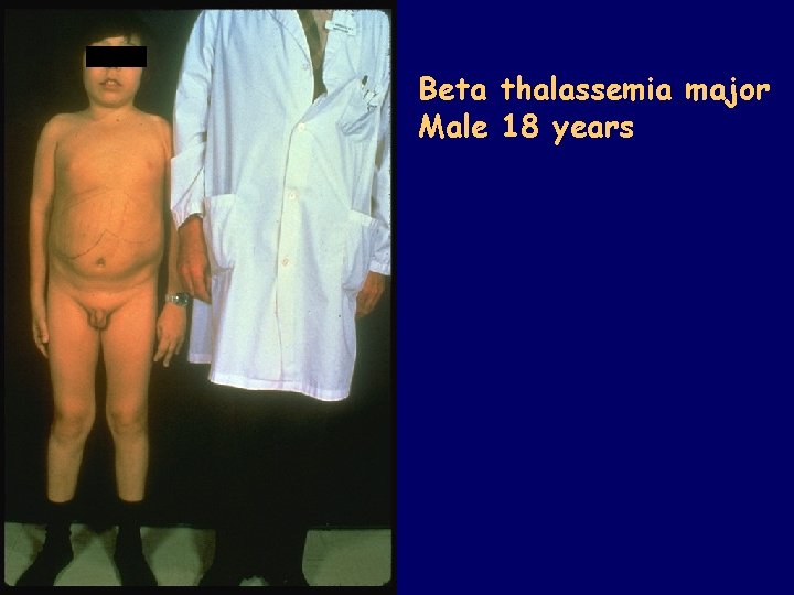 Beta thalassemia major Male 18 years 