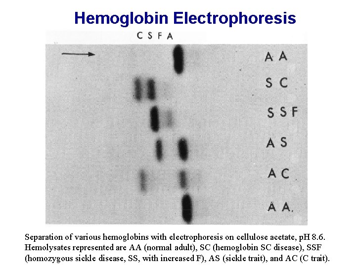 Hemoglobin Electrophoresis Separation of various hemoglobins with electrophoresis on cellulose acetate, p. H 8.