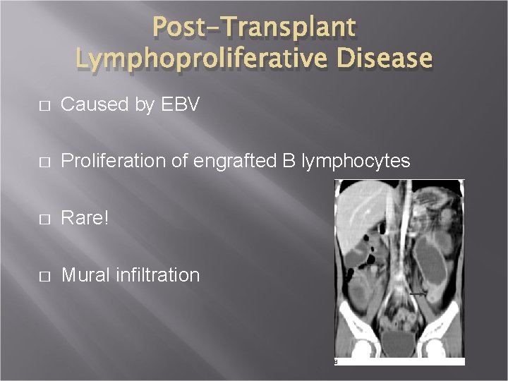 Post-Transplant Lymphoproliferative Disease � Caused by EBV � Proliferation of engrafted B lymphocytes �