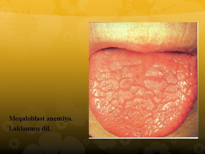 Meqaloblast anemiya. Laklanmış dil. 